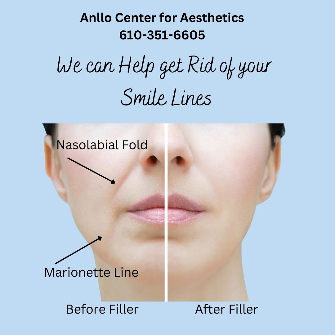 smooth-out-your-nasolabial-folds-and-marionette-lines